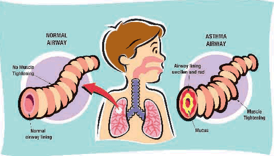 http://binhasyim.files.wordpress.com/2008/01/child-asthma.gif?w=534&h=200